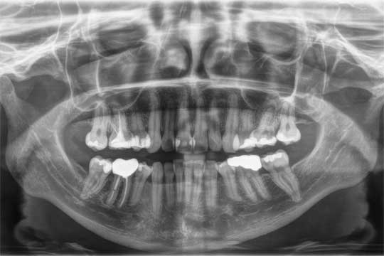 OPG Zahn-Kiefer Röntgenaufnahme