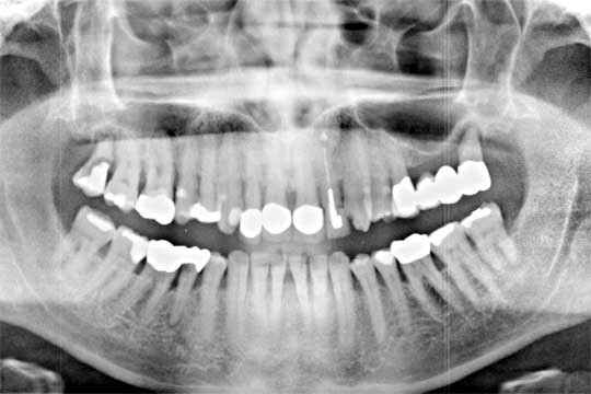 OPG Zahn-Kiefer Röntgenaufnahme